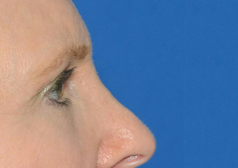 Brow Lift Before & After Gallery - Patient 366625 - Image 7