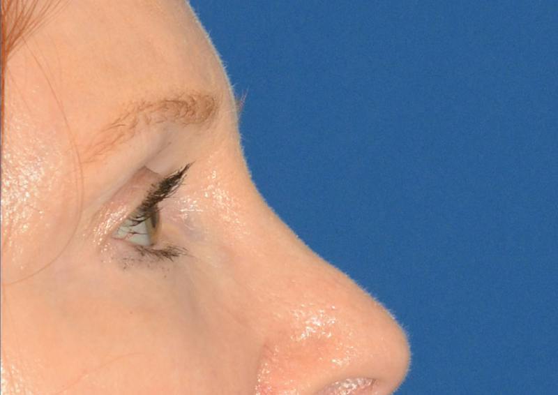 Brow Lift Before & After Gallery - Patient 366625 - Image 8
