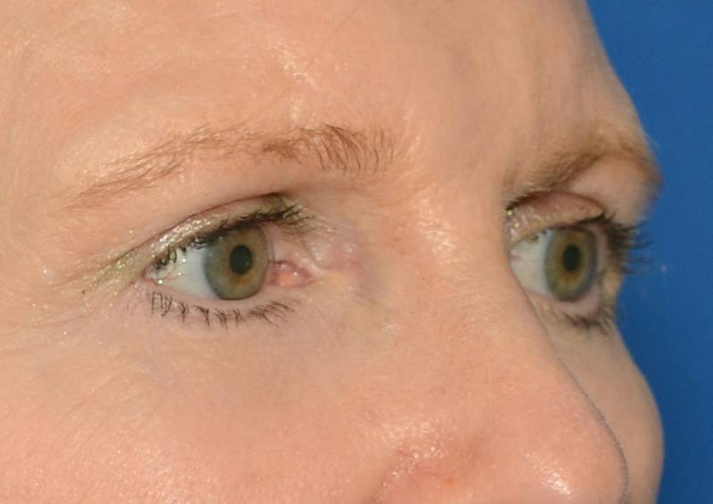 Brow Lift Before & After Gallery - Patient 366625 - Image 9
