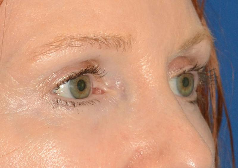 Brow Lift Before & After Gallery - Patient 366625 - Image 10