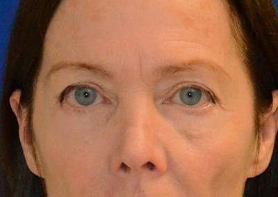 Brow Lift Before & After Gallery - Patient 189334 - Image 1