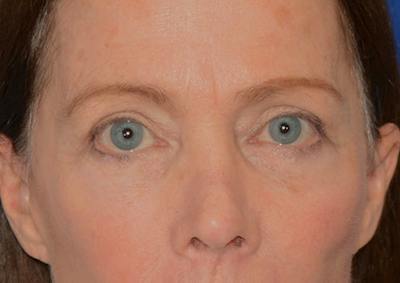Brow Lift Before & After Gallery - Patient 189334 - Image 2
