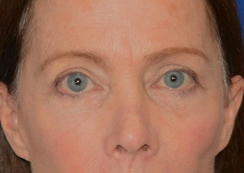 Brow Lift Before & After Gallery - Patient 189334 - Image 2