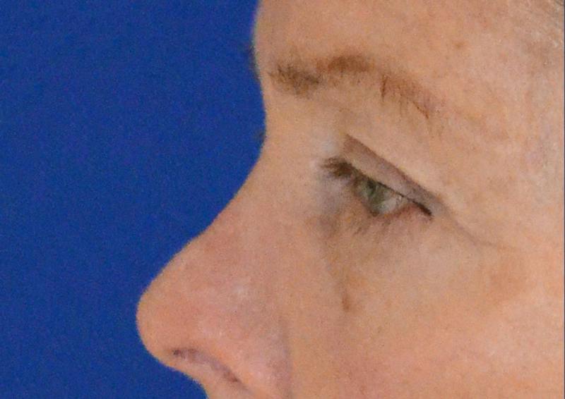 Brow Lift Before & After Gallery - Patient 189334 - Image 3
