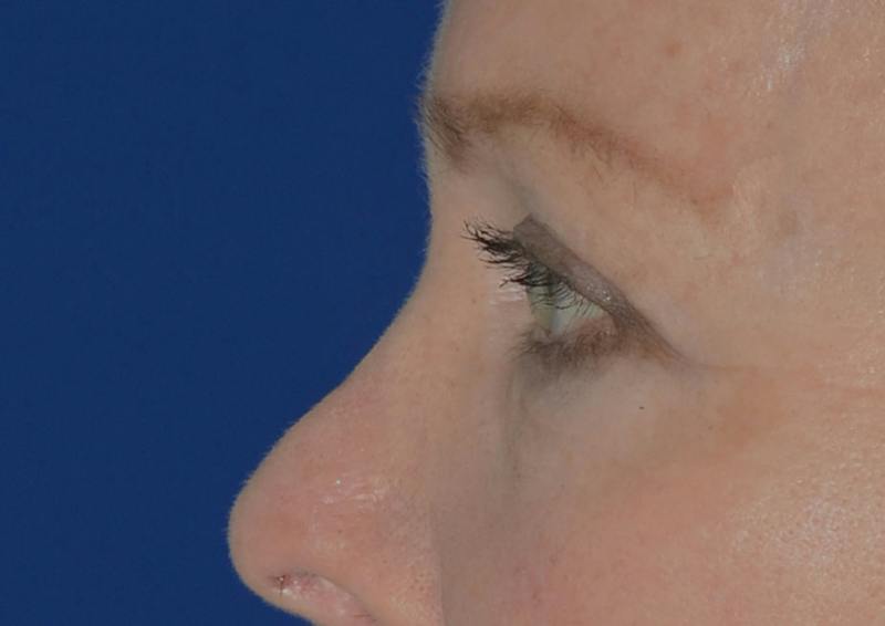 Brow Lift Before & After Gallery - Patient 189334 - Image 4