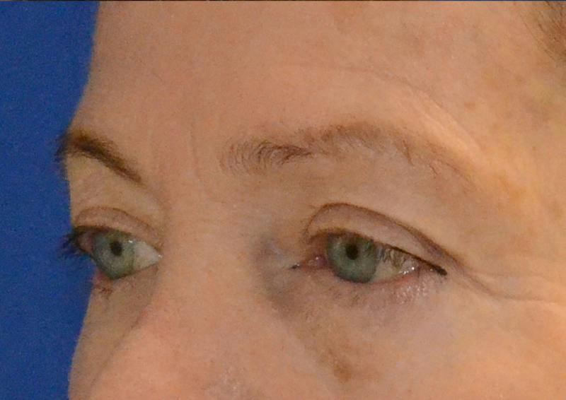 Brow Lift Before & After Gallery - Patient 189334 - Image 5
