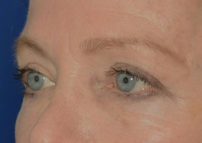 Brow Lift Before & After Gallery - Patient 189334 - Image 6