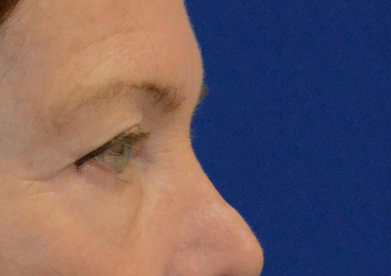 Brow Lift Before & After Gallery - Patient 189334 - Image 7