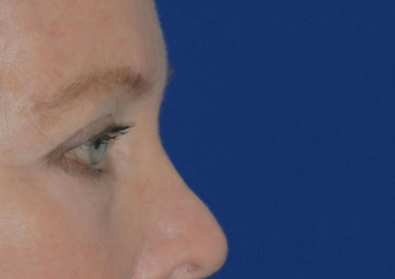 Brow Lift Before & After Gallery - Patient 189334 - Image 8