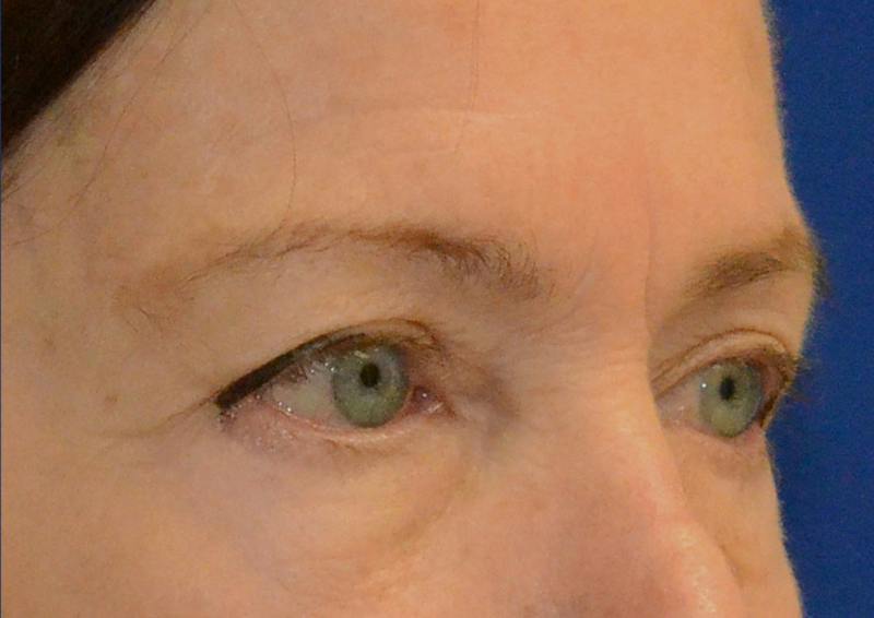Brow Lift Before & After Gallery - Patient 189334 - Image 9