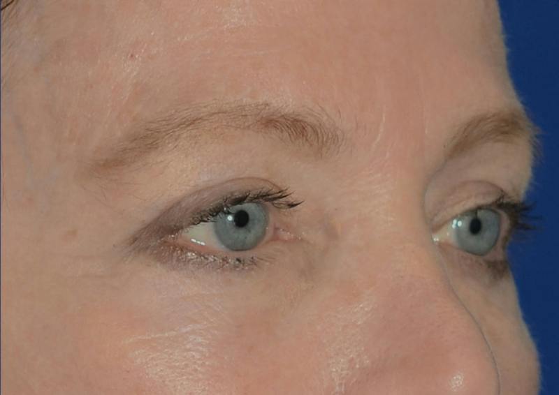 Brow Lift Before & After Gallery - Patient 189334 - Image 10