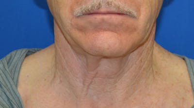 Neck Lift Before & After Gallery - Patient 963720 - Image 1