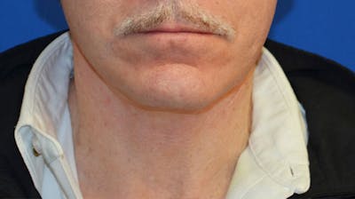 Neck Lift Before & After Gallery - Patient 963720 - Image 2