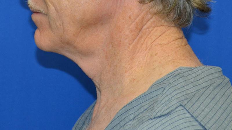 Neck Lift Before & After Gallery - Patient 963720 - Image 3