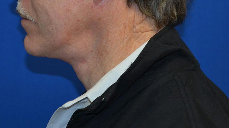 Neck Lift Before & After Gallery - Patient 963720 - Image 4