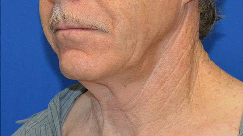 Neck Lift Before & After Gallery - Patient 963720 - Image 5