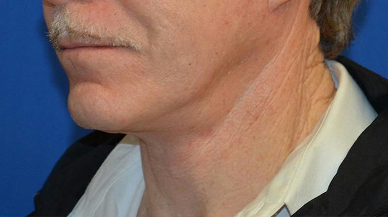 Neck Lift Before & After Gallery - Patient 963720 - Image 6