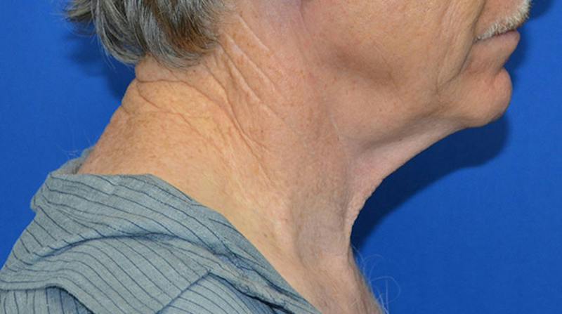 Neck Lift Before & After Gallery - Patient 963720 - Image 7