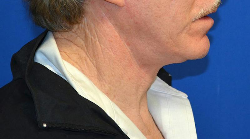 Neck Lift Before & After Gallery - Patient 963720 - Image 8