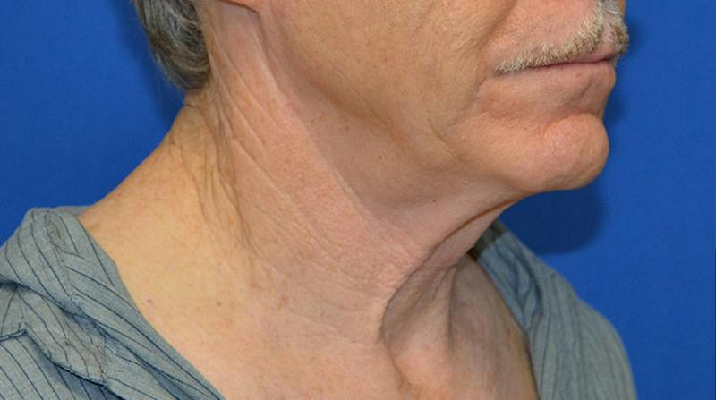 Neck Lift Before & After Gallery - Patient 963720 - Image 9
