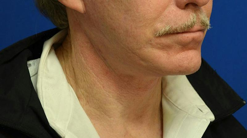 Neck Lift Before & After Gallery - Patient 963720 - Image 10