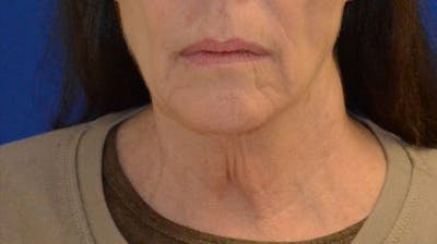 Neck Lift Before & After Gallery - Patient 339823 - Image 1
