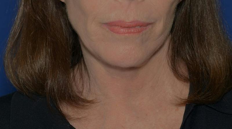 Neck Lift Before & After Gallery - Patient 339823 - Image 2