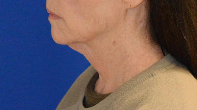 Neck Lift Before & After Gallery - Patient 339823 - Image 3