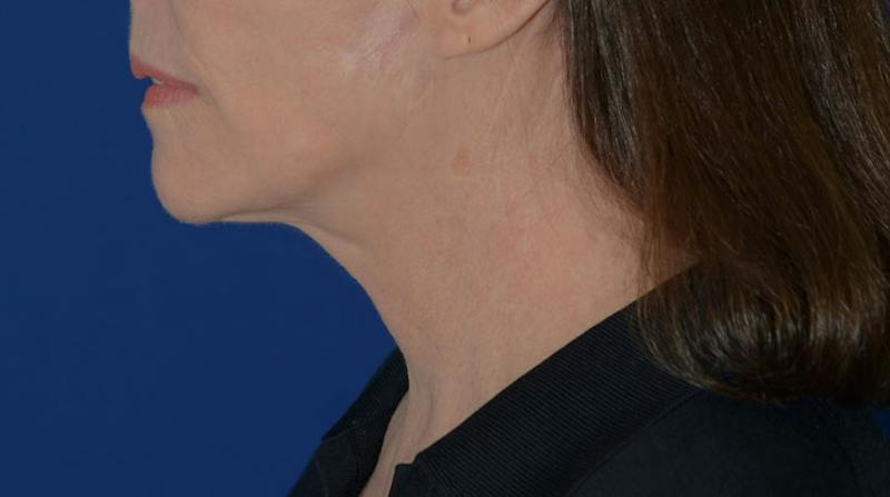 Neck Lift Before & After Gallery - Patient 339823 - Image 4