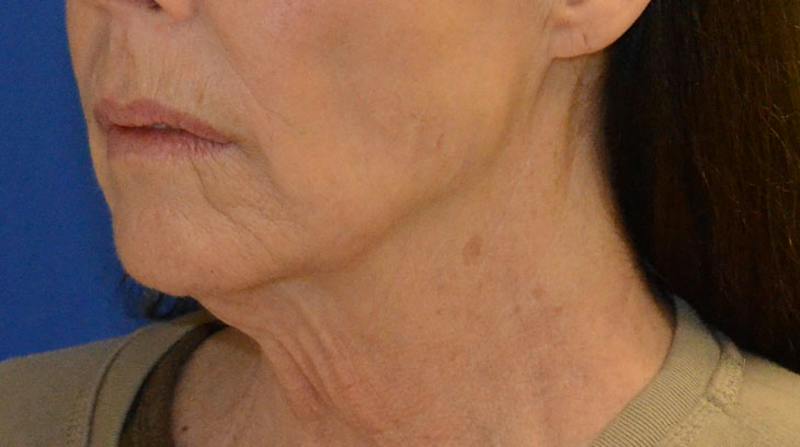 Neck Lift Before & After Gallery - Patient 339823 - Image 5