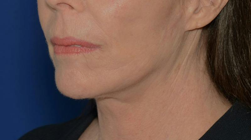Neck Lift Before & After Gallery - Patient 339823 - Image 6