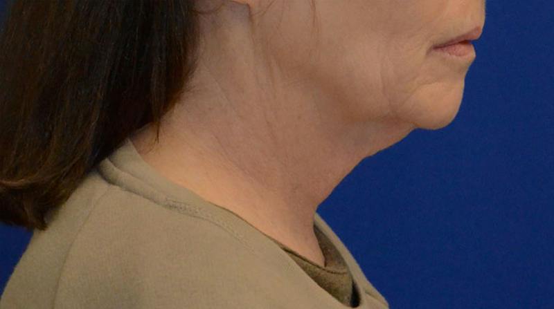 Neck Lift Before & After Gallery - Patient 339823 - Image 7
