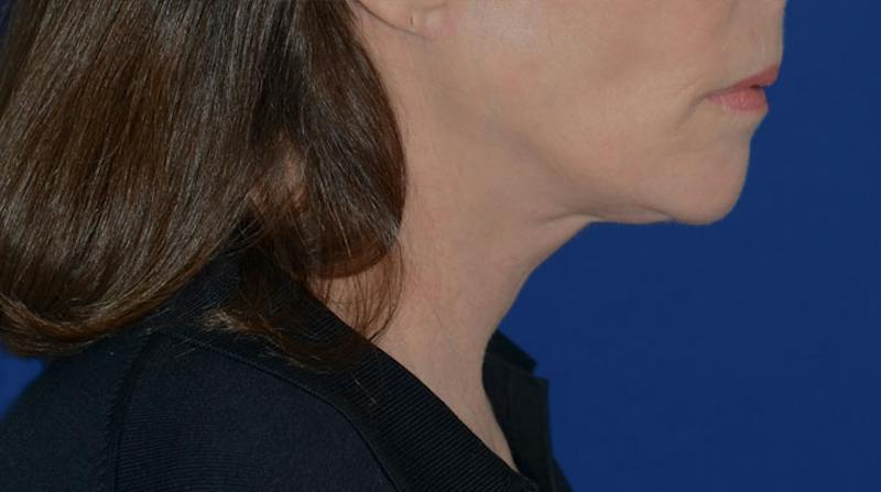 Neck Lift Before & After Gallery - Patient 339823 - Image 8