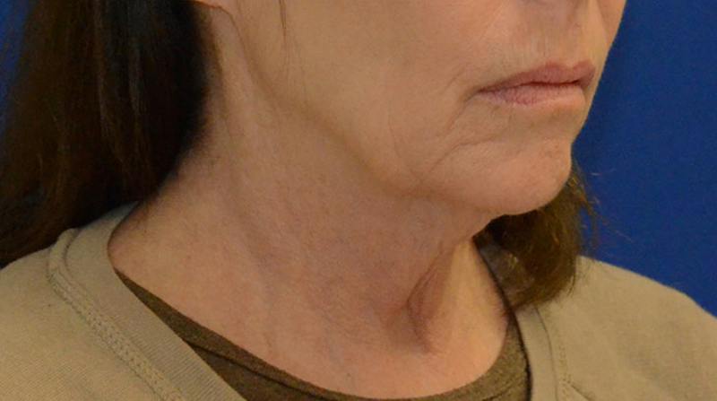 Neck Lift Before & After Gallery - Patient 339823 - Image 9