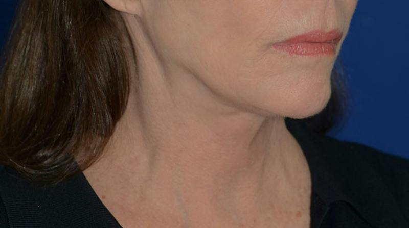 Neck Lift Before & After Gallery - Patient 339823 - Image 10