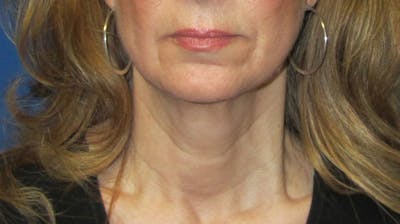 Neck Lift Before & After Gallery - Patient 196048 - Image 1