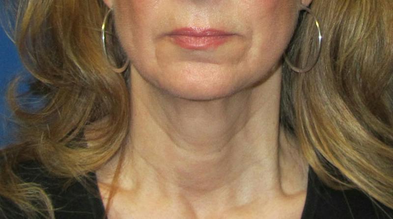 Neck Lift Before & After Gallery - Patient 196048 - Image 1