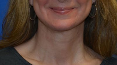 Neck Lift Before & After Gallery - Patient 196048 - Image 2
