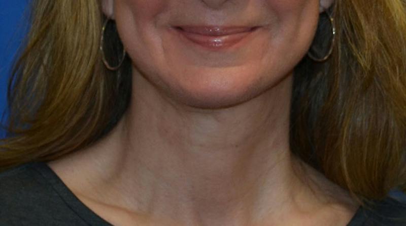 Neck Lift Before & After Gallery - Patient 196048 - Image 2