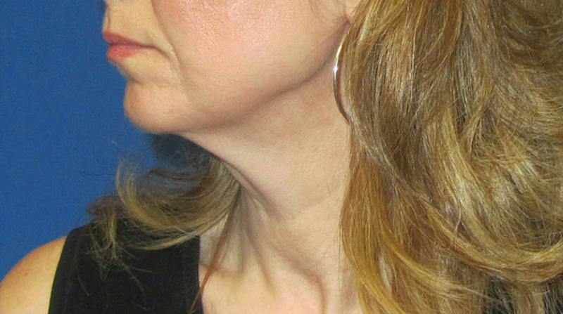 Neck Lift Before & After Gallery - Patient 196048 - Image 3