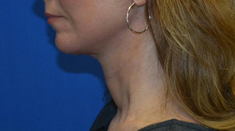 Neck Lift Before & After Gallery - Patient 196048 - Image 4