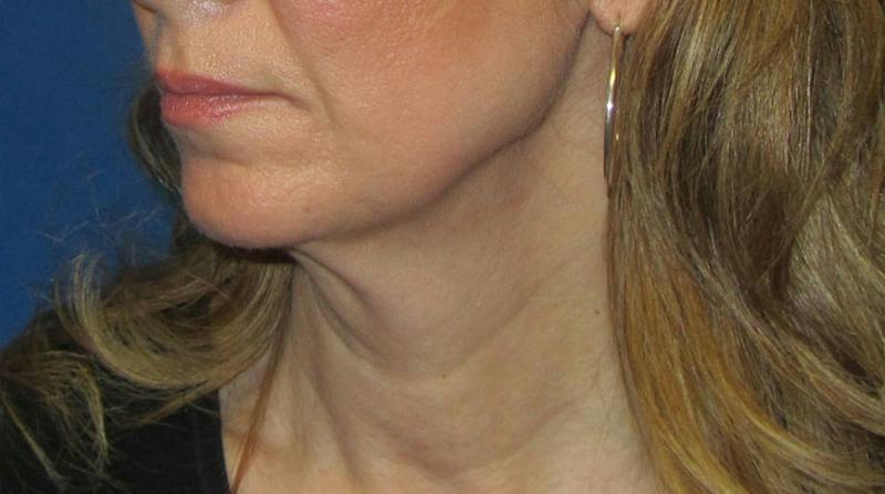 Neck Lift Before & After Gallery - Patient 196048 - Image 5
