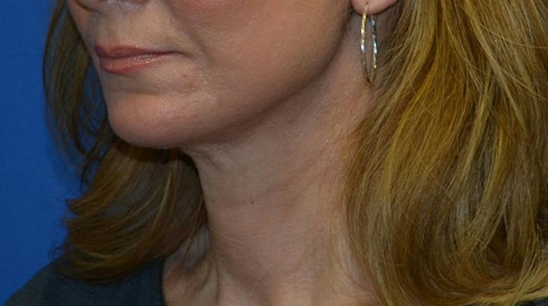Neck Lift Before & After Gallery - Patient 196048 - Image 6
