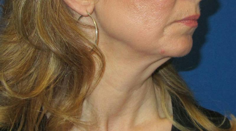 Neck Lift Before & After Gallery - Patient 196048 - Image 7