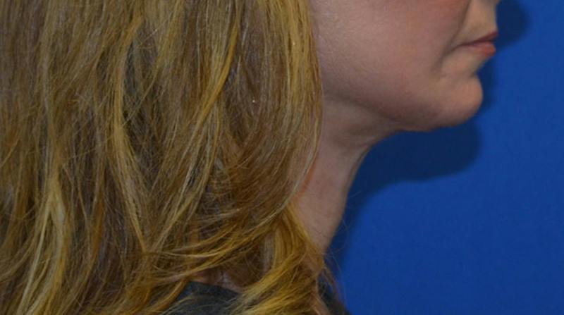 Neck Lift Before & After Gallery - Patient 196048 - Image 8
