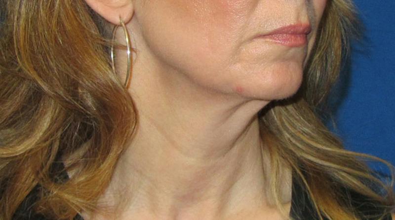 Neck Lift Before & After Gallery - Patient 196048 - Image 9