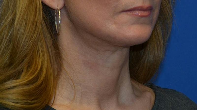 Neck Lift Before & After Gallery - Patient 196048 - Image 10