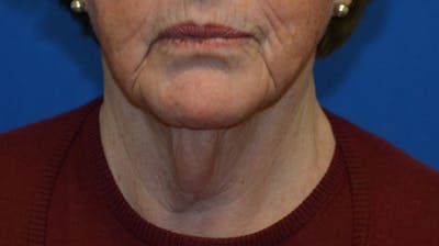 Neck Lift Before & After Gallery - Patient 152038 - Image 1