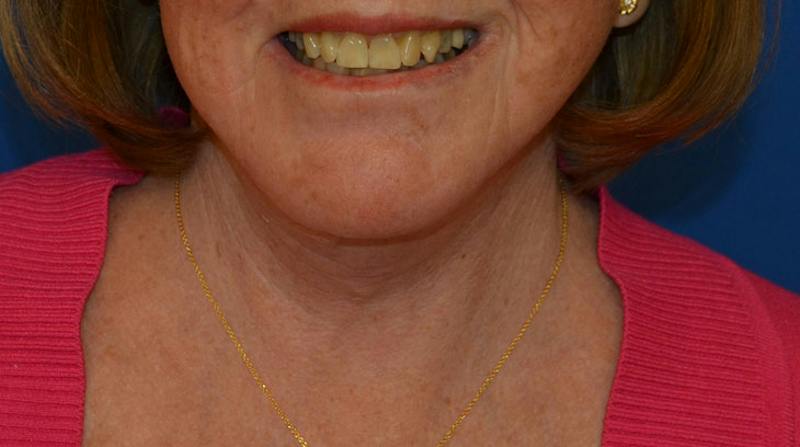 Neck Lift Before & After Gallery - Patient 152038 - Image 2