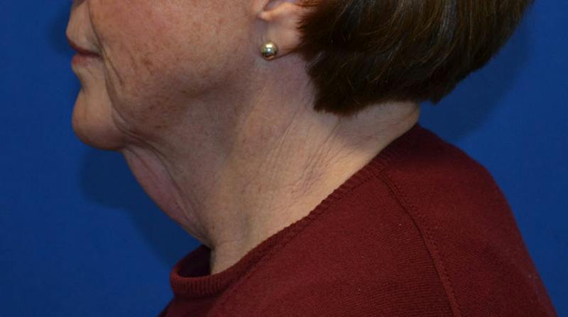 Neck Lift Before & After Gallery - Patient 152038 - Image 3